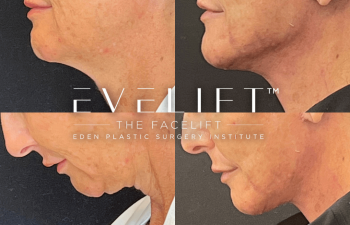 female patient before and after EVELift®