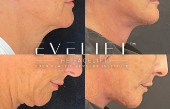 female patient before and after EVELift®