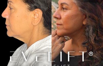 female patient before and after EVELift®