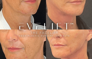 female patient before and after EVELift®