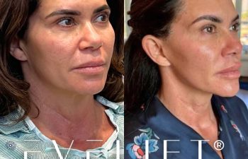 female patient before and after EVELift®
