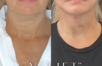 female patient before and after EVELift®