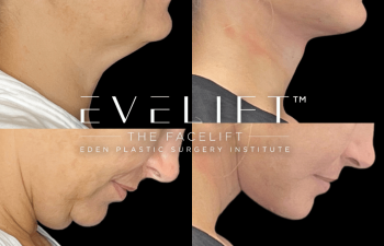 female patient before and after EVELift®
