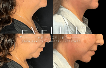female patient before and after EVELift®