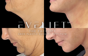 female patient before and after EVELift®