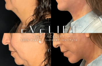 female patient before and after EVELift®