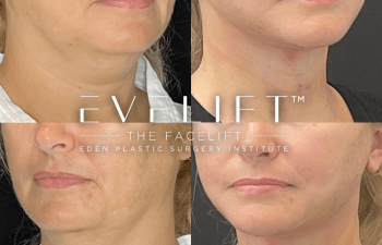 female patient before and after EVELift®