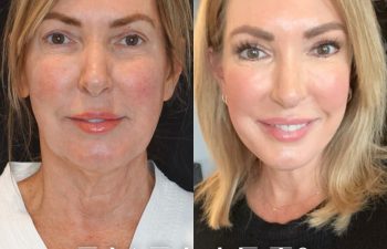 female patient before and after EVELift®