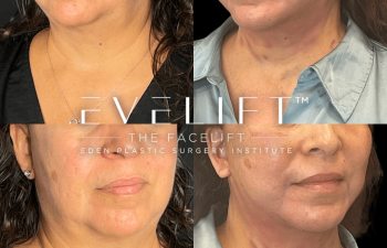 female patient before and after EVELift®