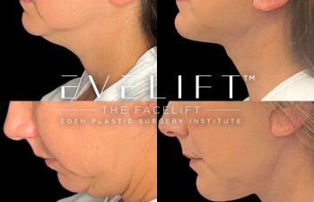 female patient before and after EVELift®