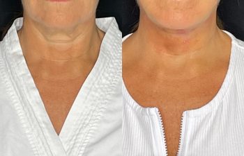 female patient before and after EVELift®
