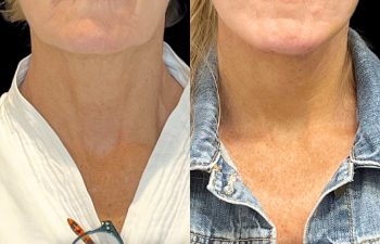 female patient before and after EVELift®