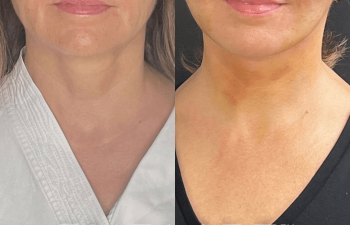 female patient before and after EVELift®
