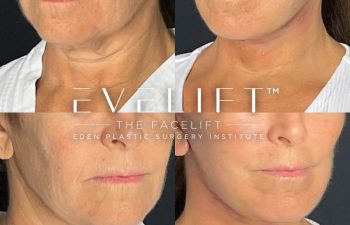 female patient before and after EVELift®