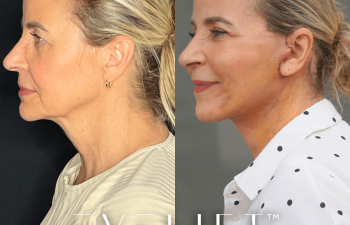 female patient before and after EVELift®