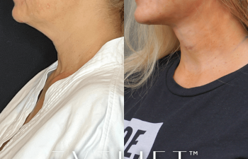 female patient before and after EVELift®