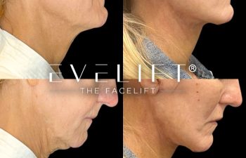 female patient before and after EVELift®