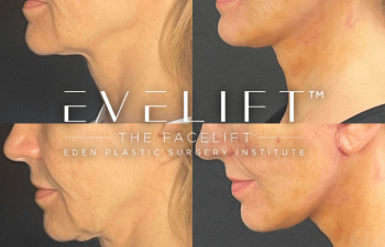 female patient before and after EVELift®