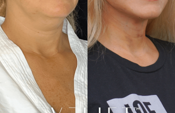 female patient before and after EVELift®
