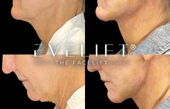 female patient before and after EVELift®