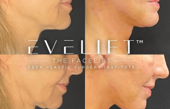 female patient before and after EVELift®
