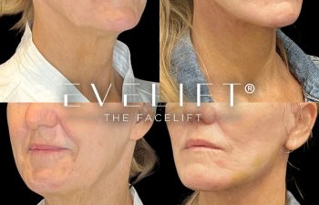 female patient before and after EVELift®