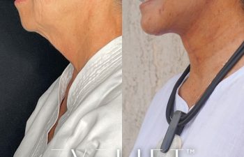 female patient before and after EVELift®