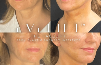 female patient before and after EVELift®