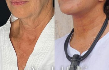 female patient before and after EVELift®