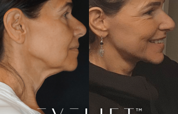 female patient before and after EVELift®