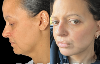 female patient before and after EVELift®