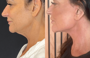 female patient before and after EVELift®