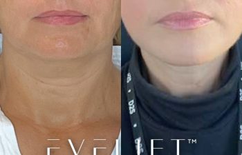female patient before and after EVELift®
