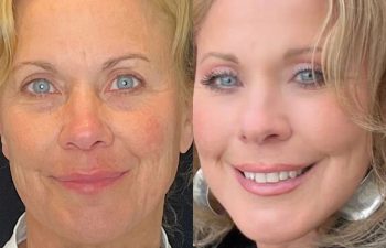 female patient before and after EVELift®