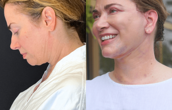 female patient before and after EVELift®