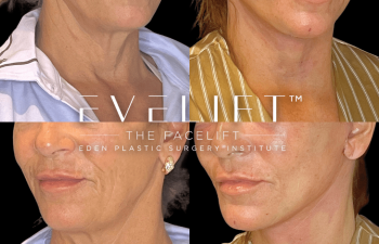 female patient before and after EVELift®