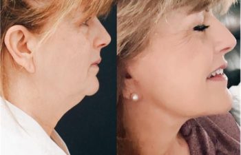 female patient before and after EVELift®