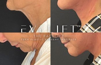 female patient before and after EVELift®