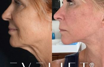 female patient before and after EVELift®