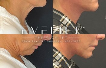 female patient before and after EVELift®