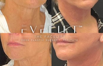 female patient before and after EVELift®