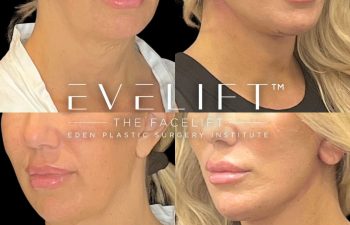 female patient before and after EVELift®