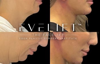 female patient before and after EVELift®