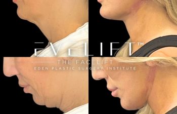 female patient before and after EVELift®