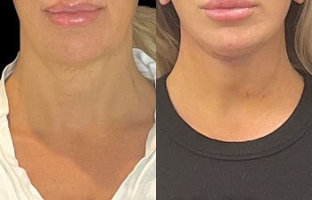 female patient before and after EVELift®