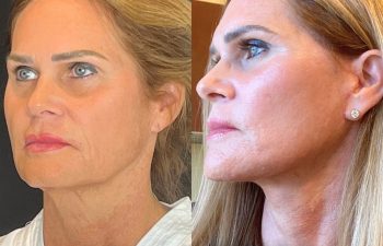 female patient before and after EVELift®