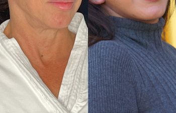 female patient before and after EVELift®