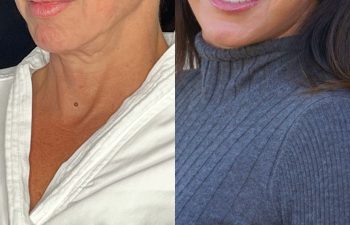 female patient before and after EVELift®