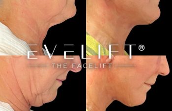 female patient before and after EVELift®