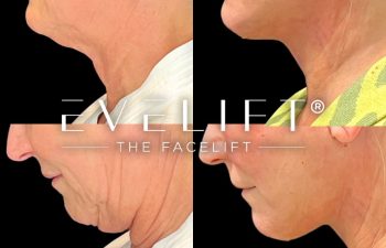 female patient before and after EVELift®